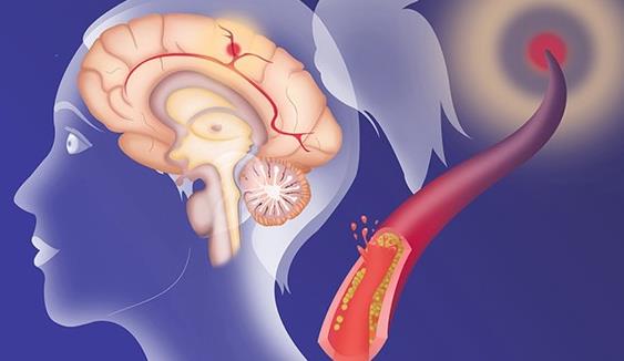 脑出血能完全康复吗 脑出血的病人怎么快速恢复正常?
